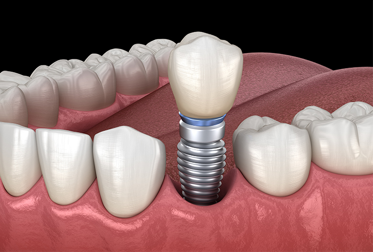 Implant Dentistry