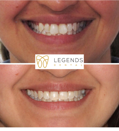 Before and after photos of teeth after Invisalign treatment