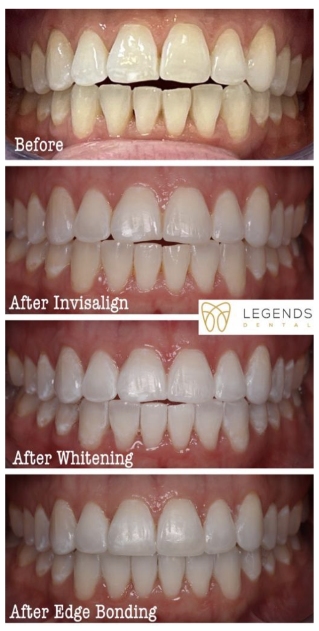 before and after teeth photo of invisalign and cosmetic treatment