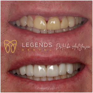 Before and after photo of veneers