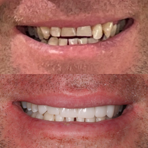Before and after veneers